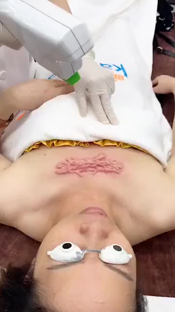Sẹo lồi ở ngực - Cộm. ngữa. đau, mất tự tin